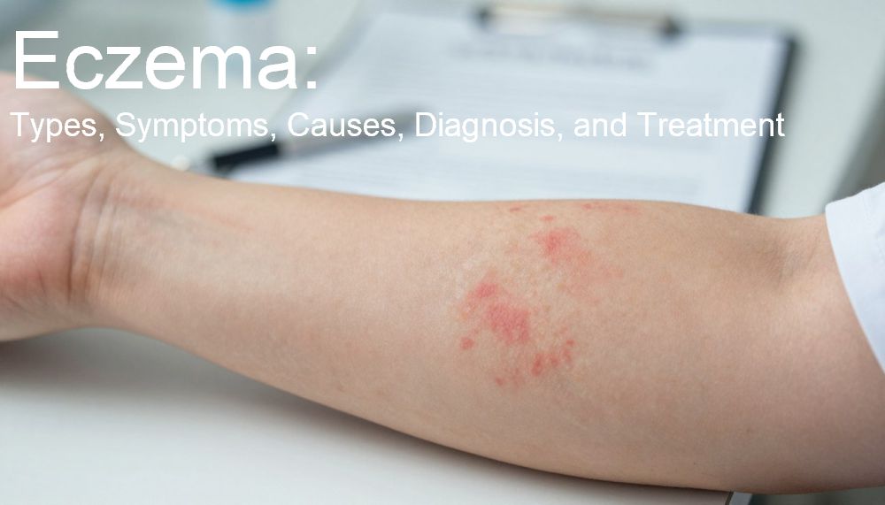 Eczema: Types, Symptoms, Causes, Diagnosis, and Treatment